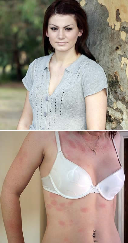 Aquagenic Urticaria