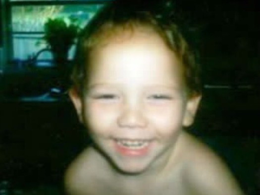 Arnold Chiari Malformation