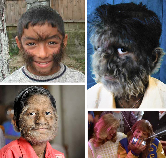 Hypertrichosis (Werewolf Syndrome)