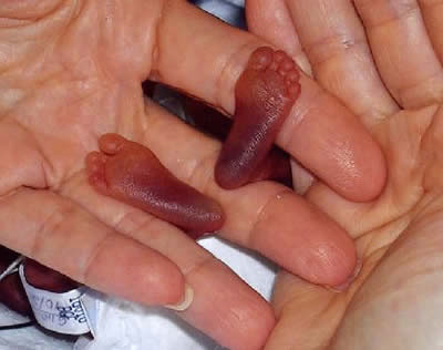 World's Smallest Baby