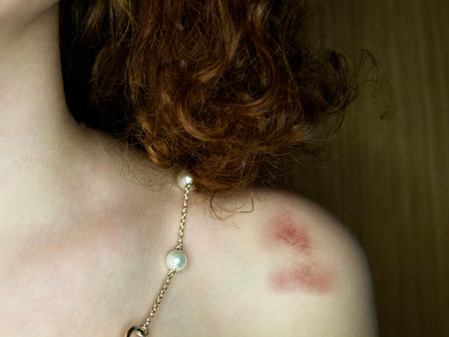 bruise