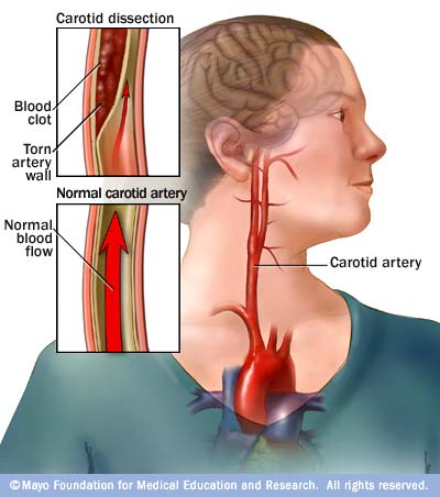 Carotid Artery Dissection