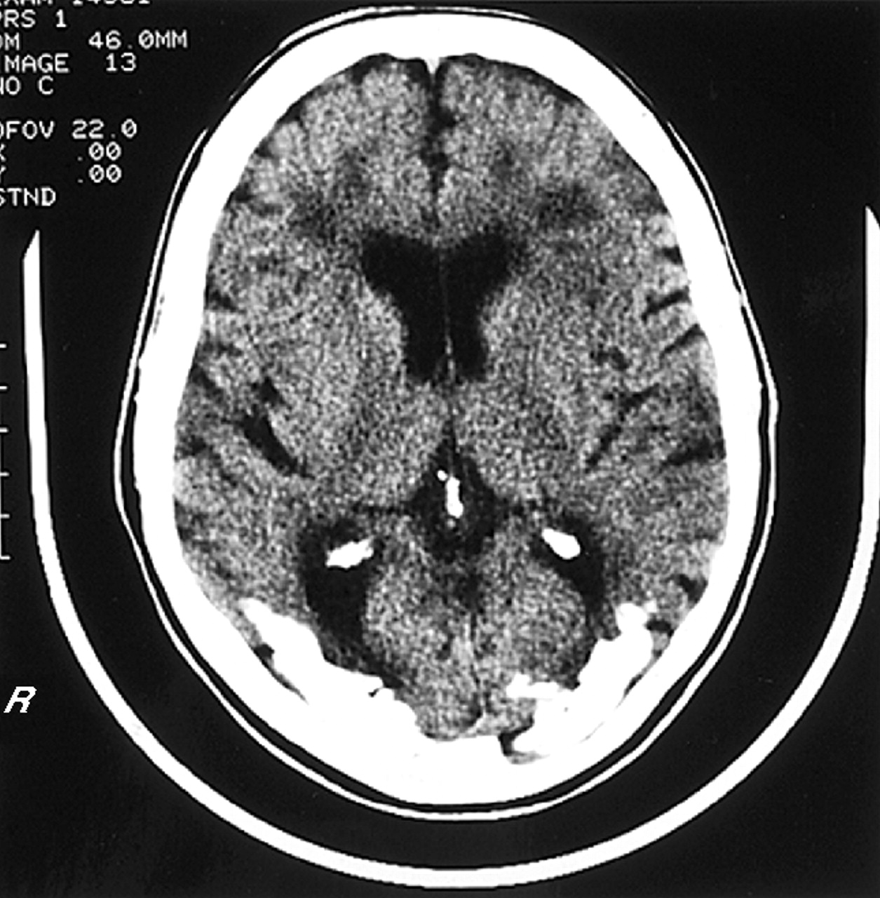 Coeliac Disease