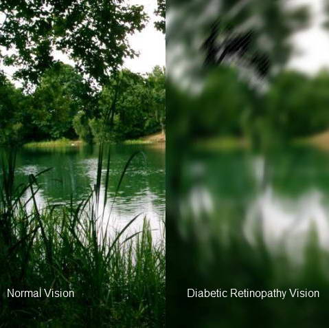 Diabetic Retinopathy