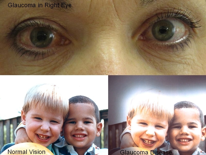 Glaucoma-Disease