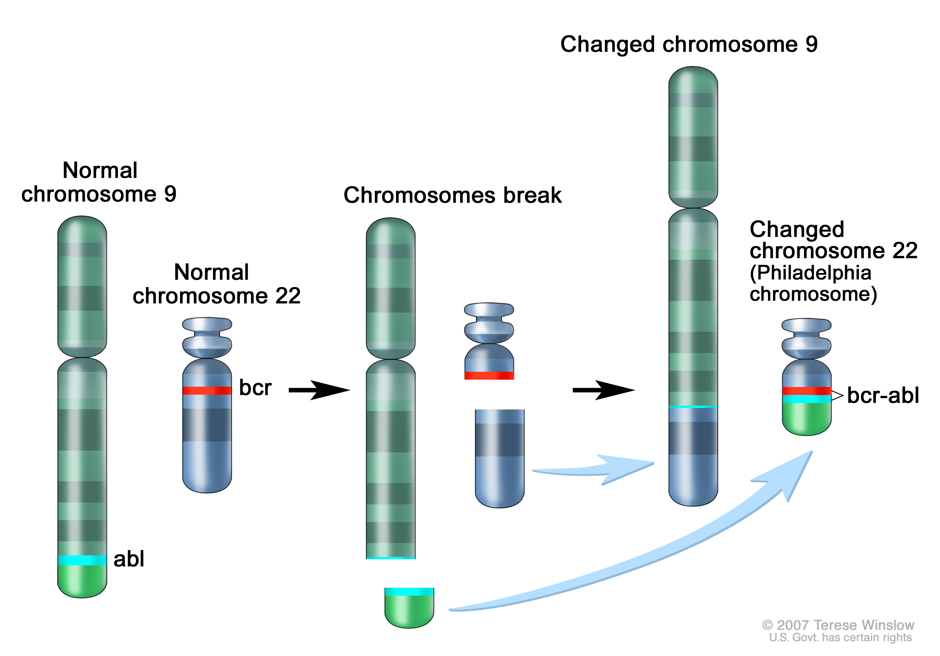 Philadelphia chromosome in Chronic Myelogenous (or Myeloid) Leukemia